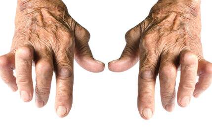 Rheumatoide Arthritis – Therapie