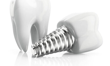 Possibilités et limites du traitement par implants – Zahnimplantate