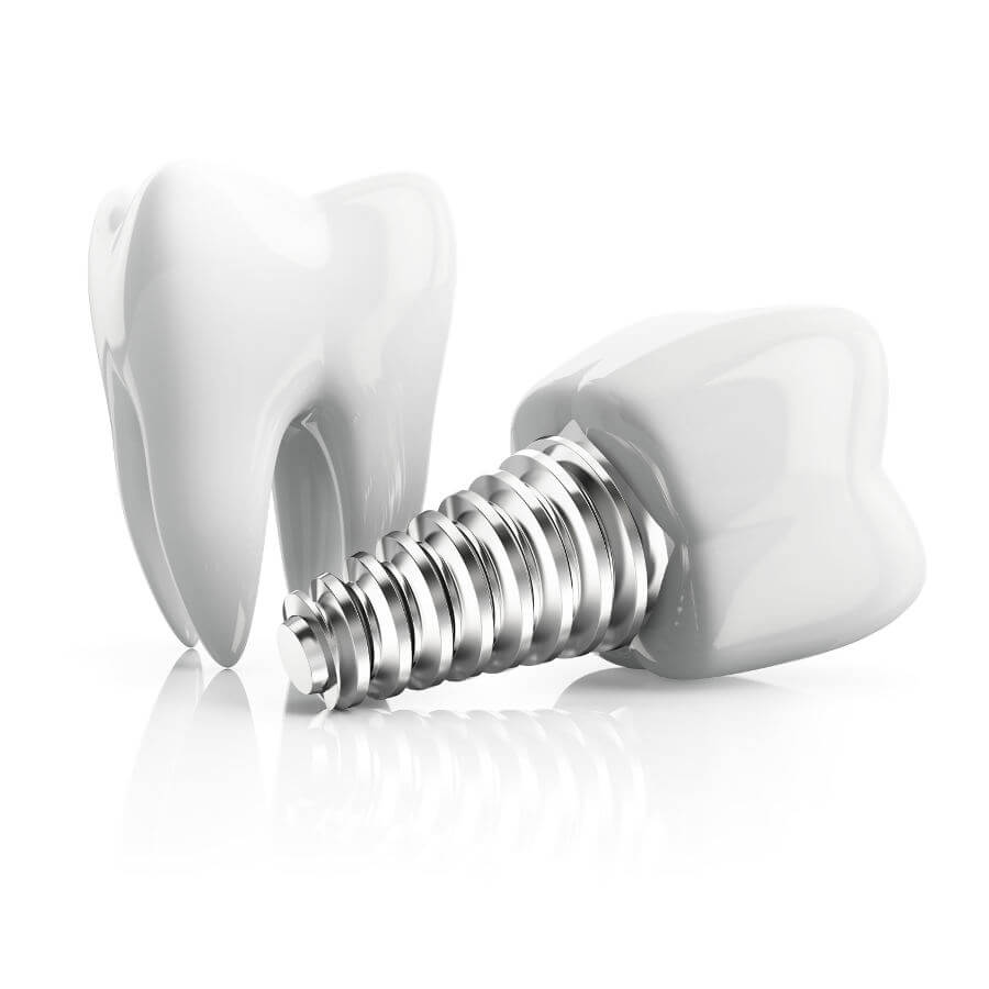 Possibilités et limites du traitement par implants - Zahnimplantate