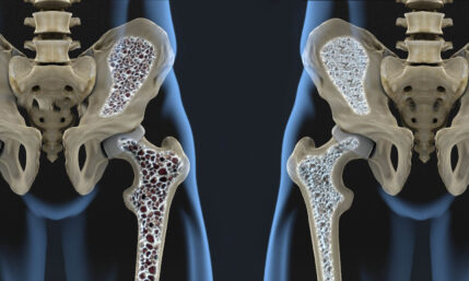 Osteoporose – Auslöser für viele Altersfrakturen