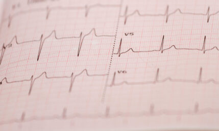 Vorhofflimmern – häufigste Herzrhythmusstörung