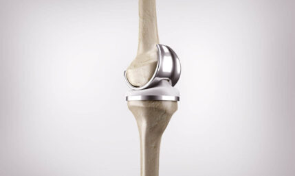 Kniegelenk-Prothese bei Arthrose
