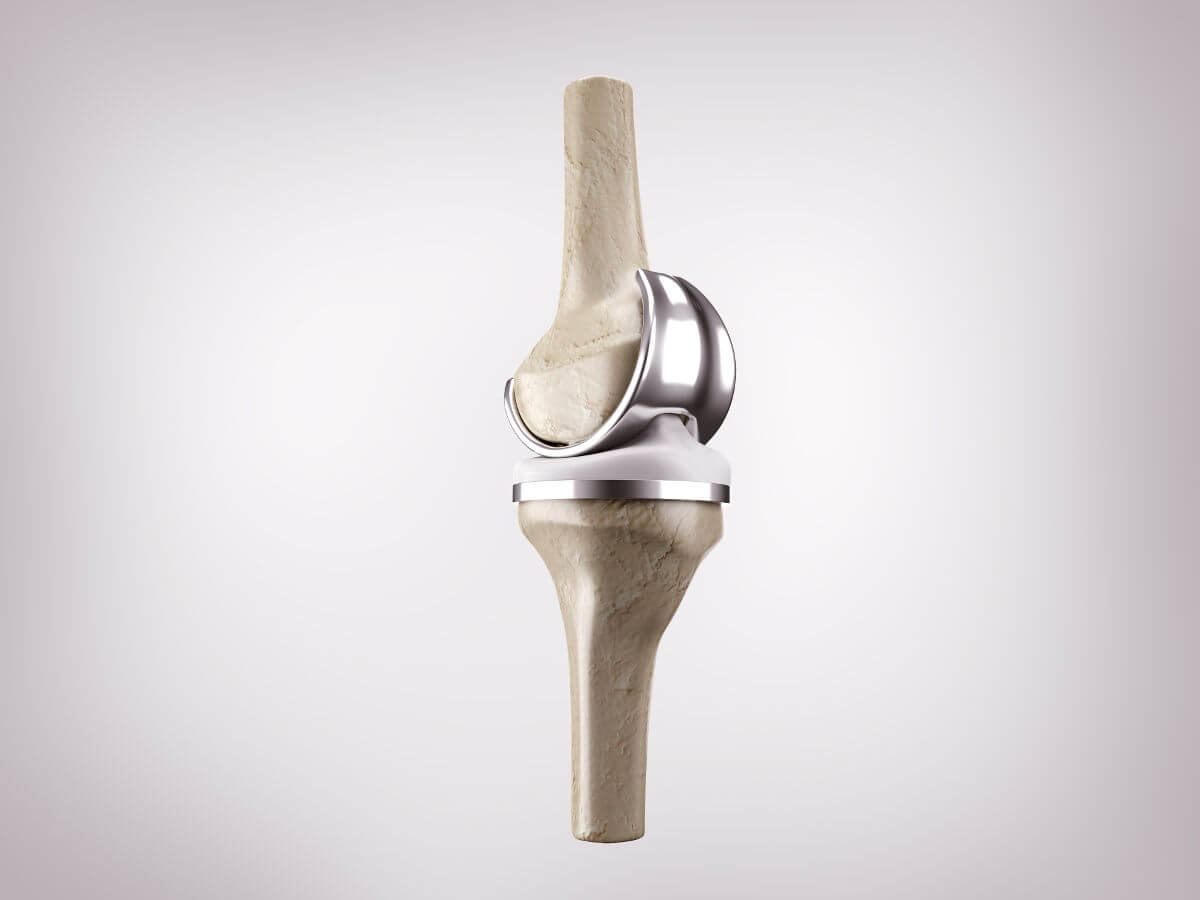 Kniegelenk-Prothese bei Arthrose