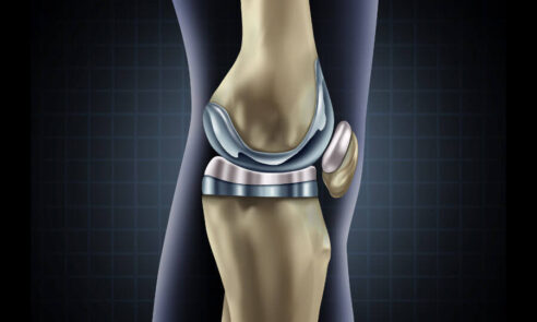 Arthrose im Knie – künstliches Gelenk als Lösung